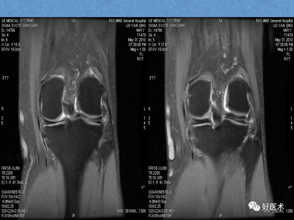 膝关节MRI高清解剖图解，值得收藏！