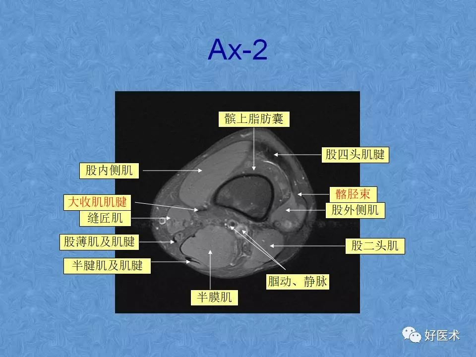 膝关节MRI高清解剖图解，值得收藏！