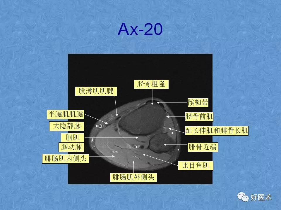 膝关节MRI高清解剖图解，值得收藏！