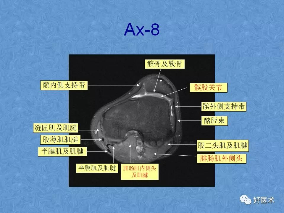 膝关节MRI高清解剖图解，值得收藏！