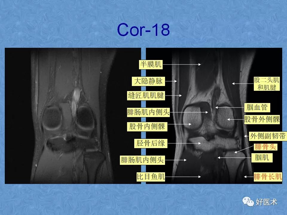 膝关节MRI高清解剖图解，值得收藏！