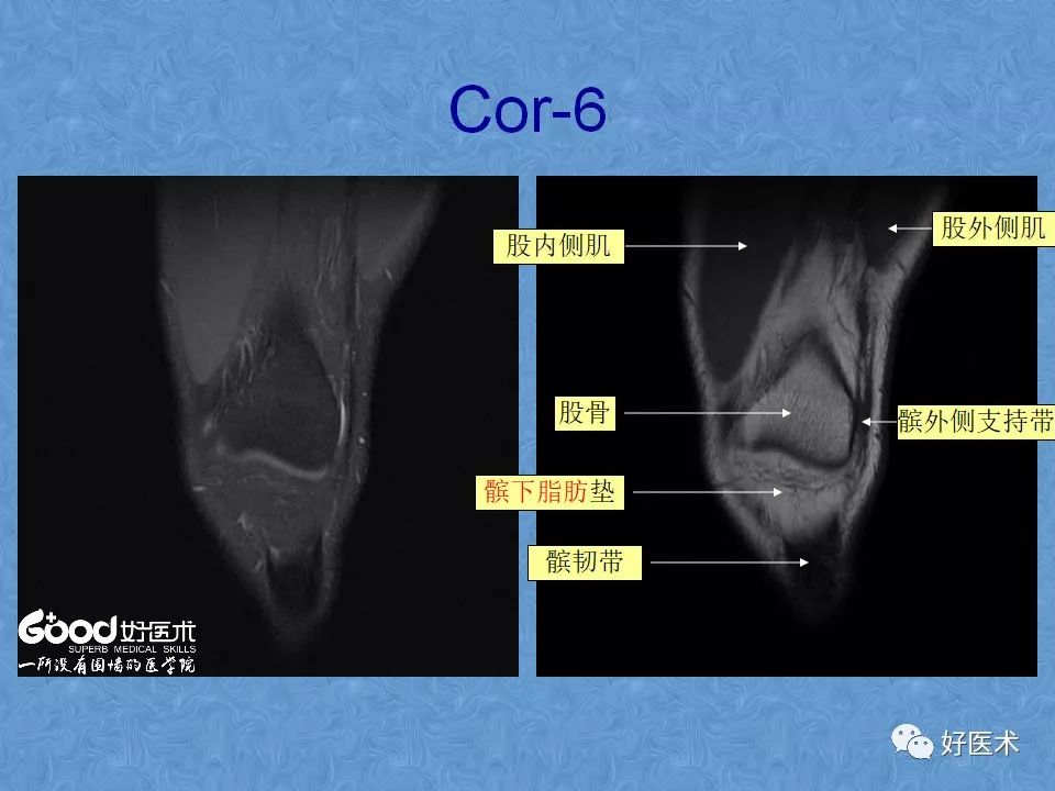 膝关节MRI高清解剖图解，值得收藏！