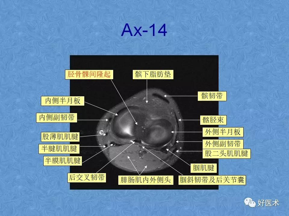 膝关节MRI高清解剖图解，值得收藏！