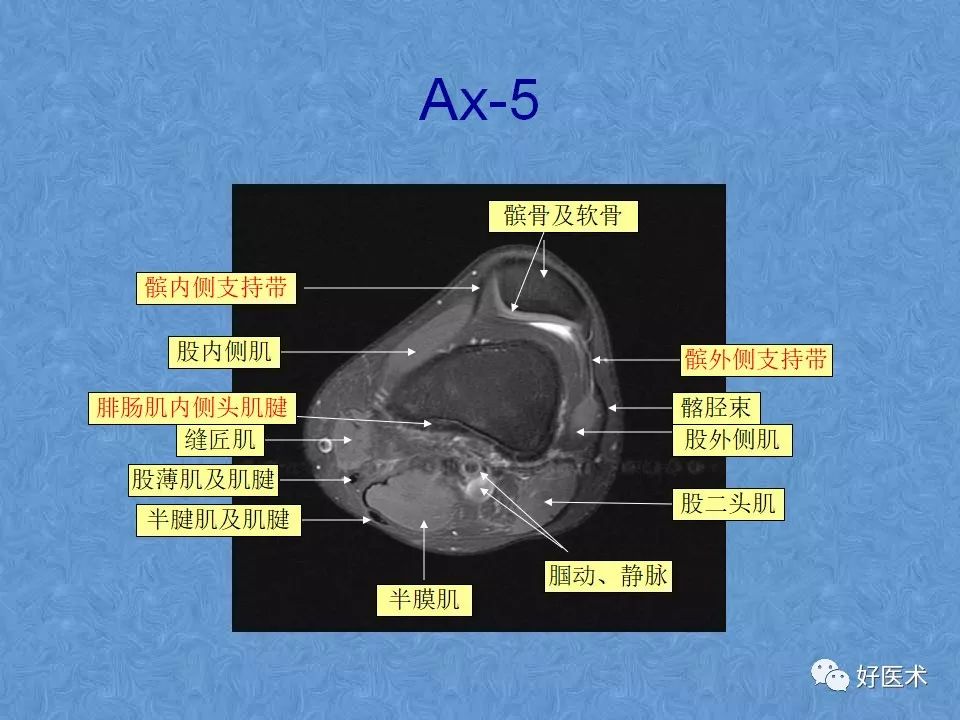 膝关节MRI高清解剖图解，值得收藏！