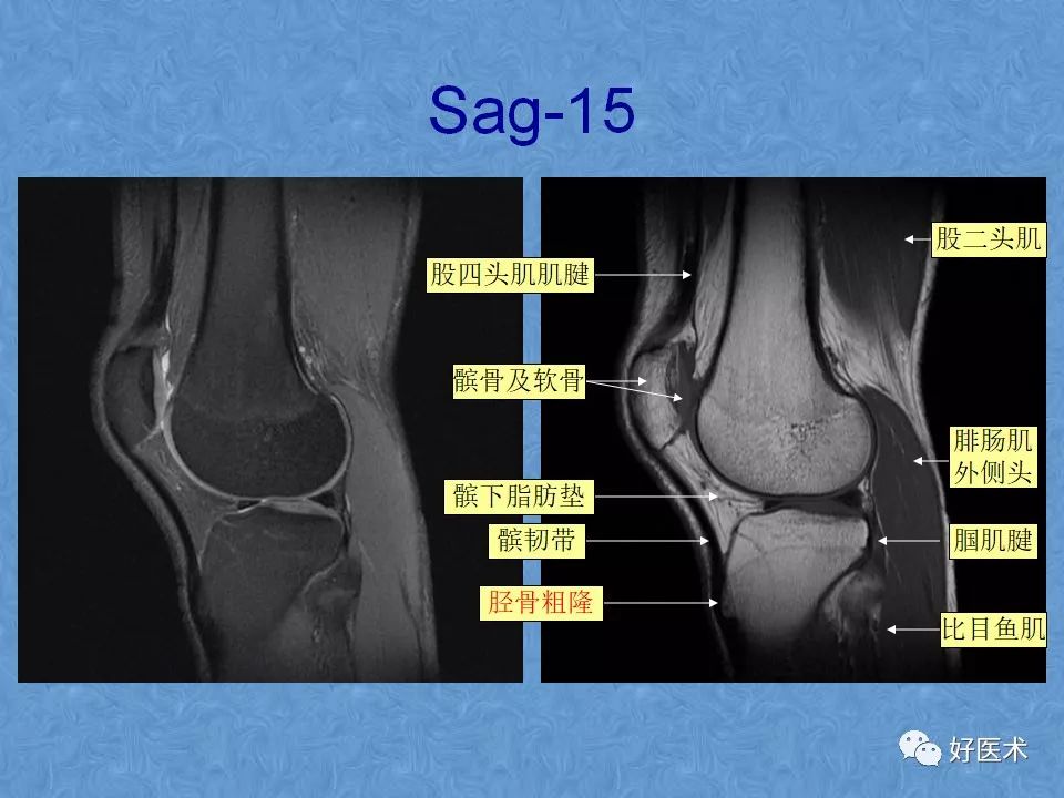 膝关节MRI高清解剖图解，值得收藏！