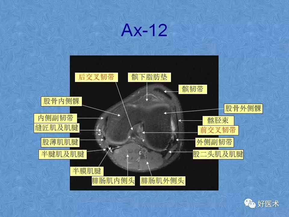 膝关节MRI高清解剖图解，值得收藏！