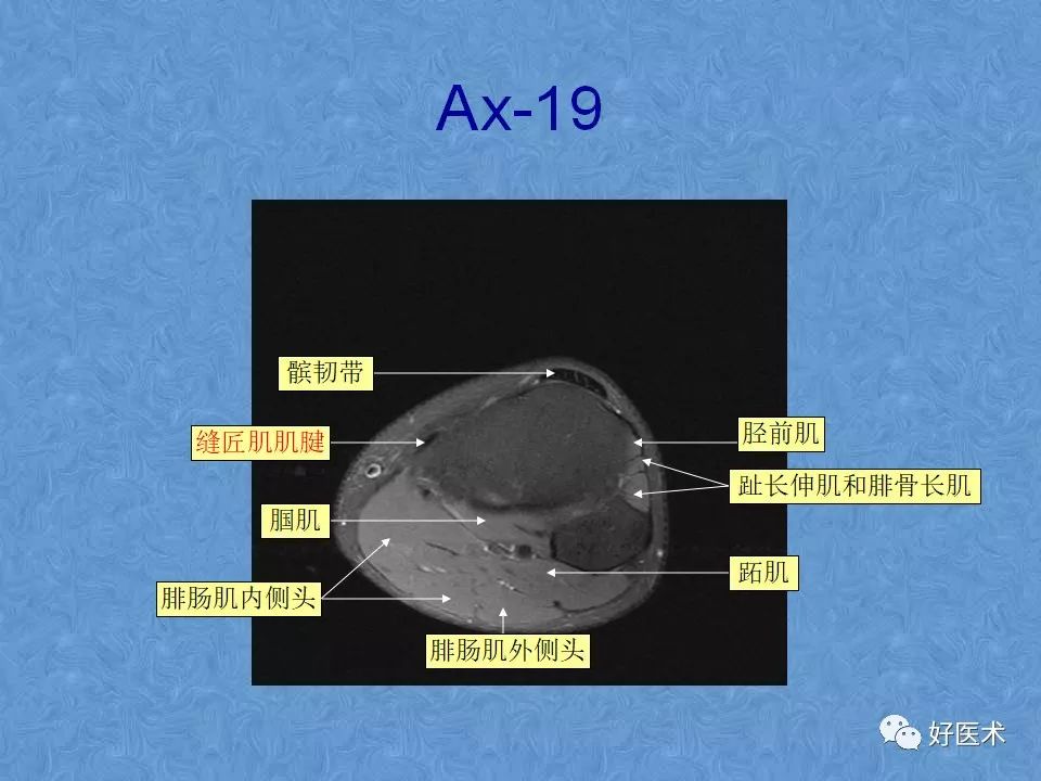 膝关节MRI高清解剖图解，值得收藏！