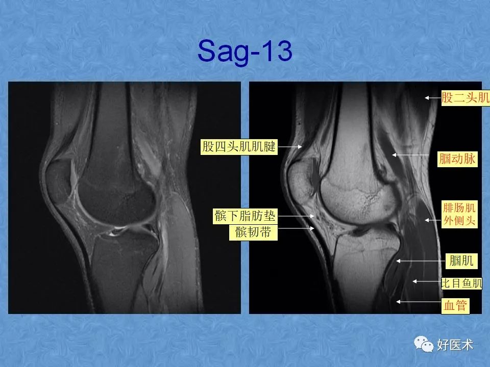 膝关节MRI高清解剖图解，值得收藏！