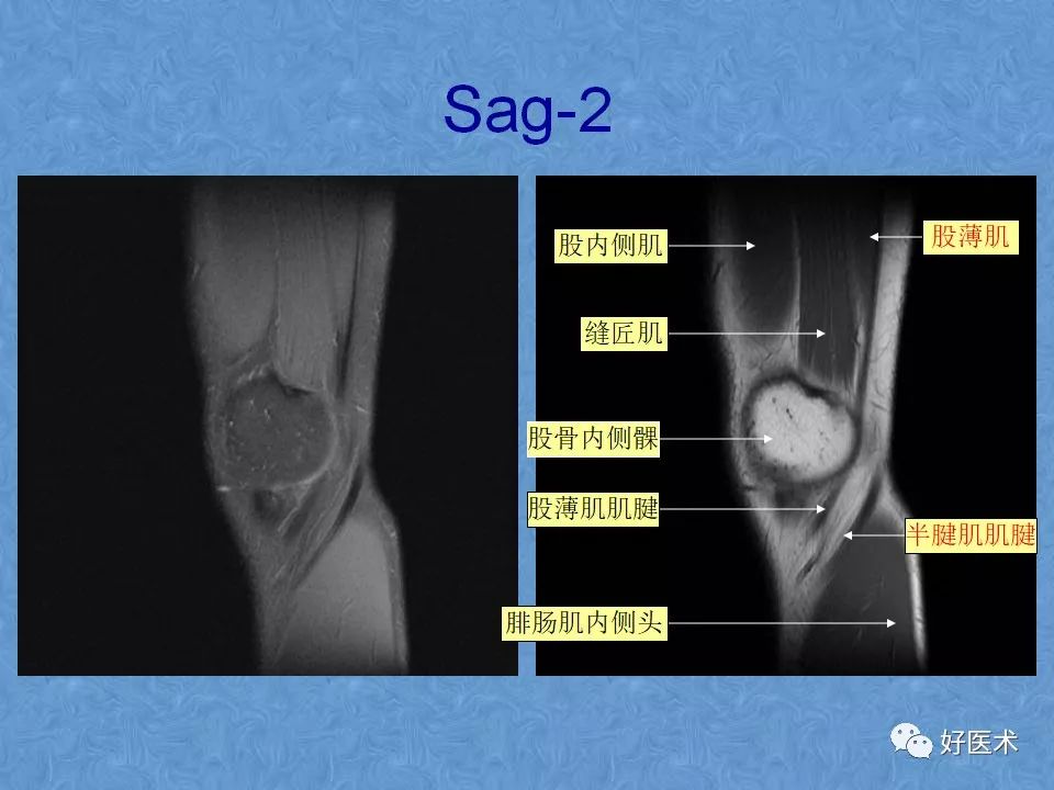 膝关节MRI高清解剖图解，值得收藏！