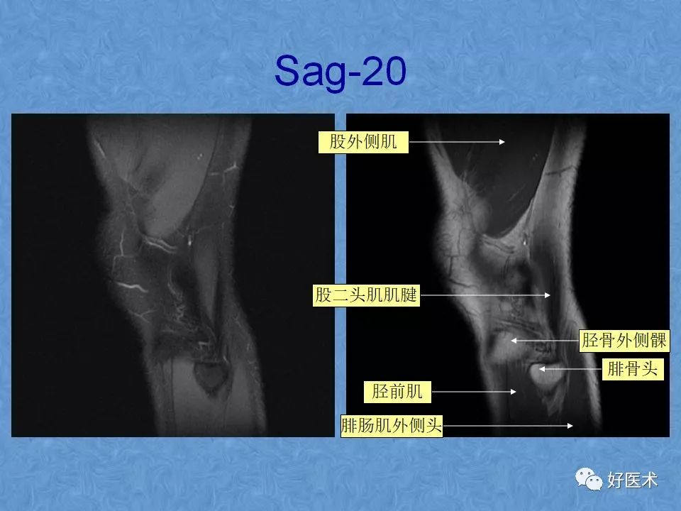 膝关节MRI高清解剖图解，值得收藏！
