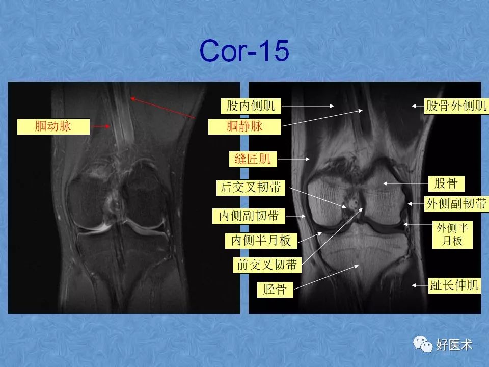 膝关节MRI高清解剖图解，值得收藏！