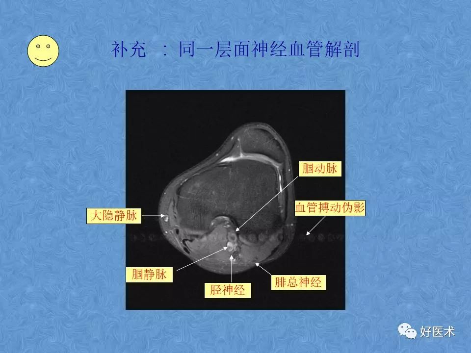 膝关节MRI高清解剖图解，值得收藏！