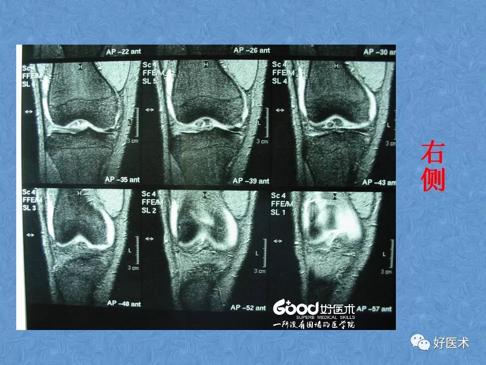 膝关节MRI高清解剖图解，值得收藏！