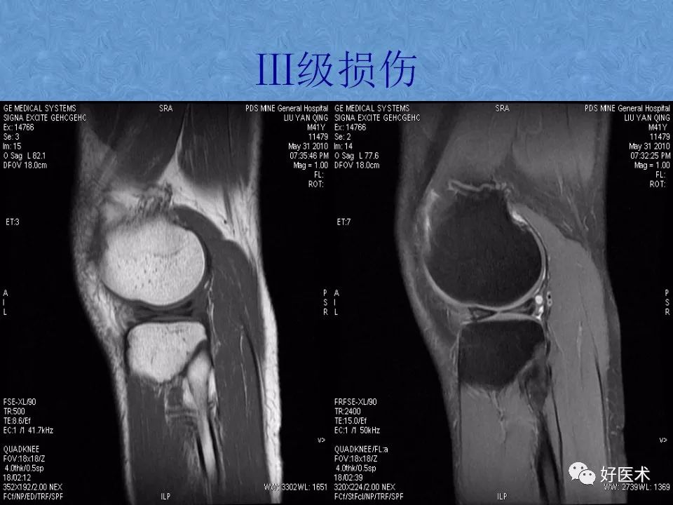 膝关节MRI高清解剖图解，值得收藏！