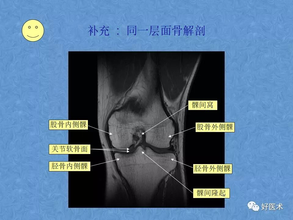 膝关节MRI高清解剖图解，值得收藏！