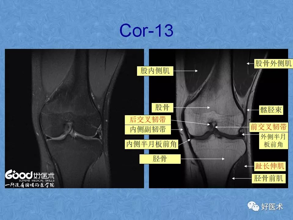 膝关节MRI高清解剖图解，值得收藏！