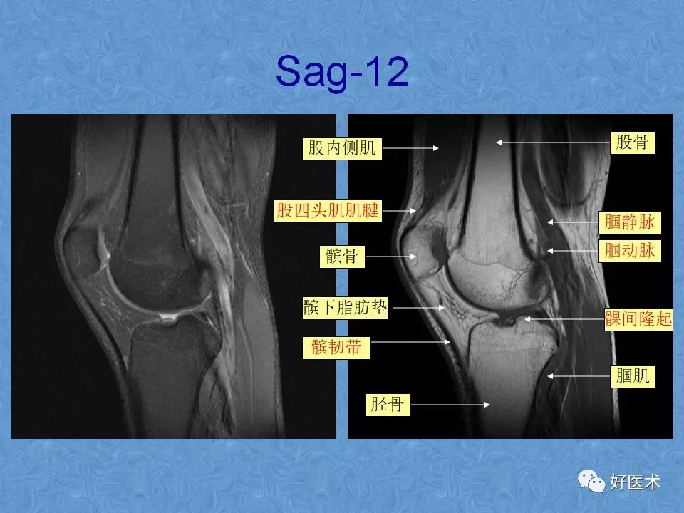 膝关节MRI高清解剖图解，值得收藏！