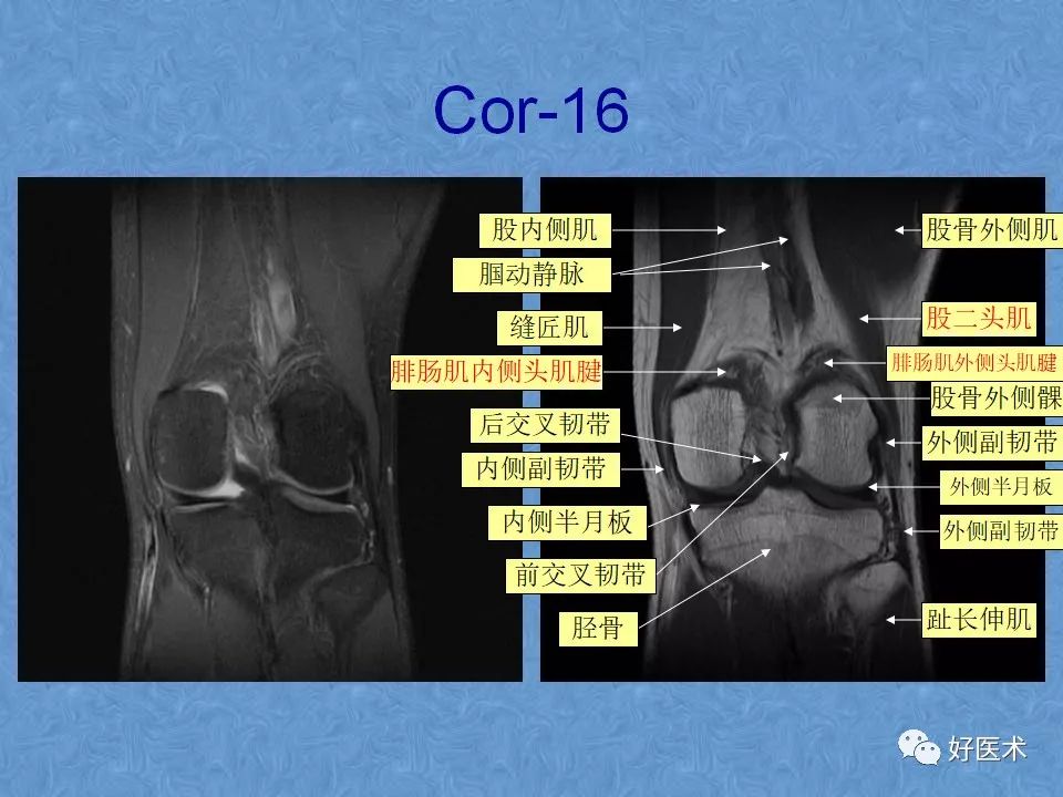 膝关节MRI高清解剖图解，值得收藏！