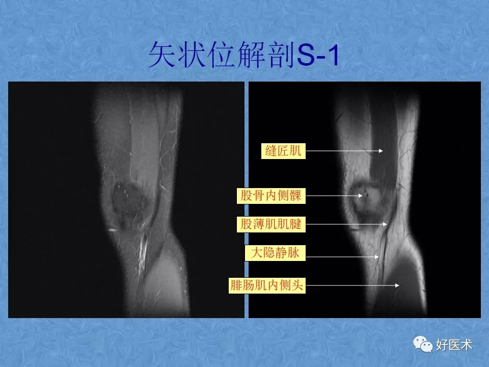 膝关节MRI高清解剖图解，值得收藏！