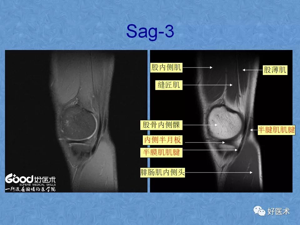 膝关节MRI高清解剖图解，值得收藏！