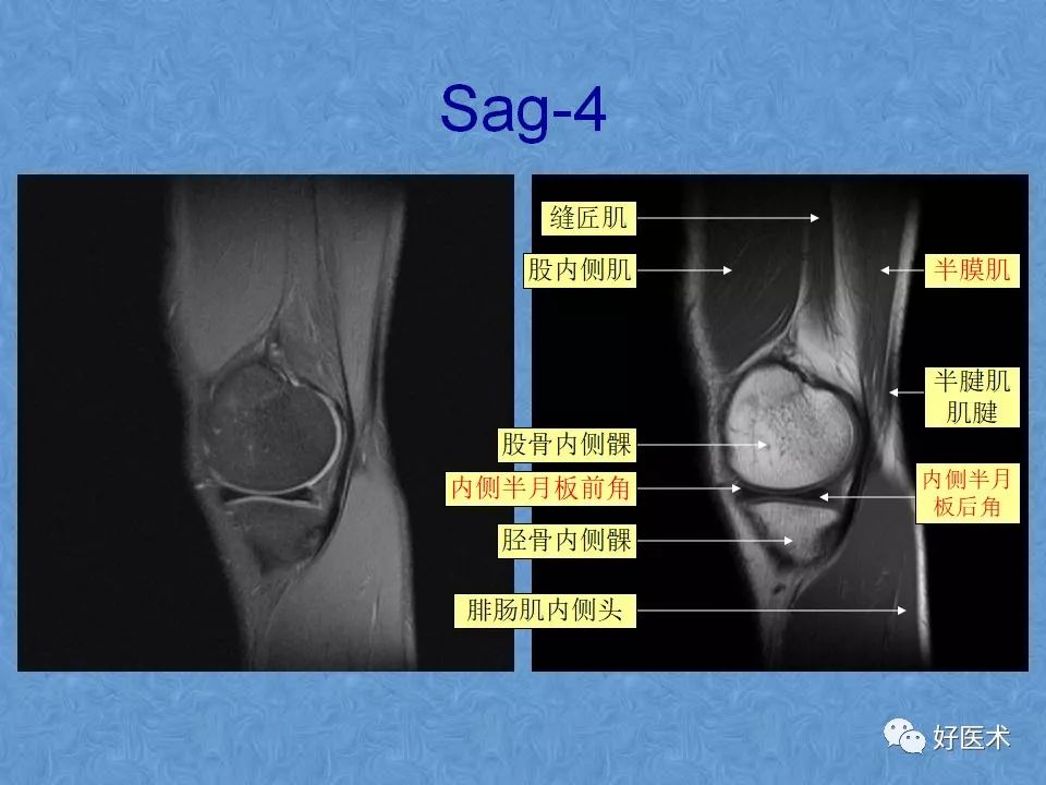 膝关节MRI高清解剖图解，值得收藏！