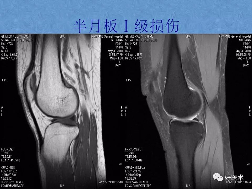 膝关节MRI高清解剖图解，值得收藏！