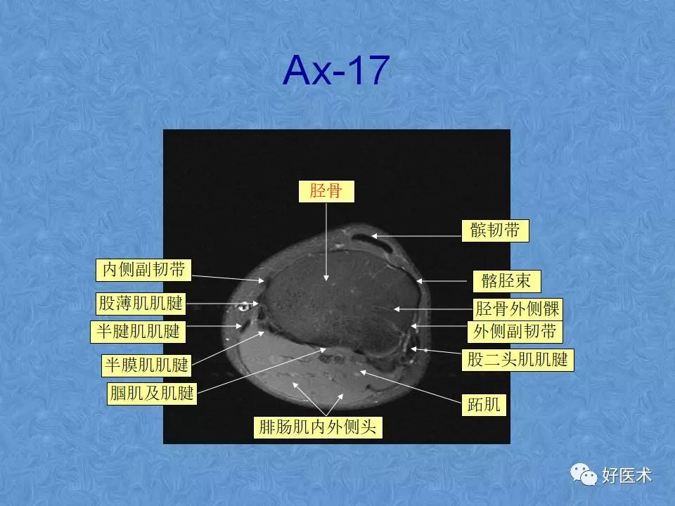 膝关节MRI高清解剖图解，值得收藏！