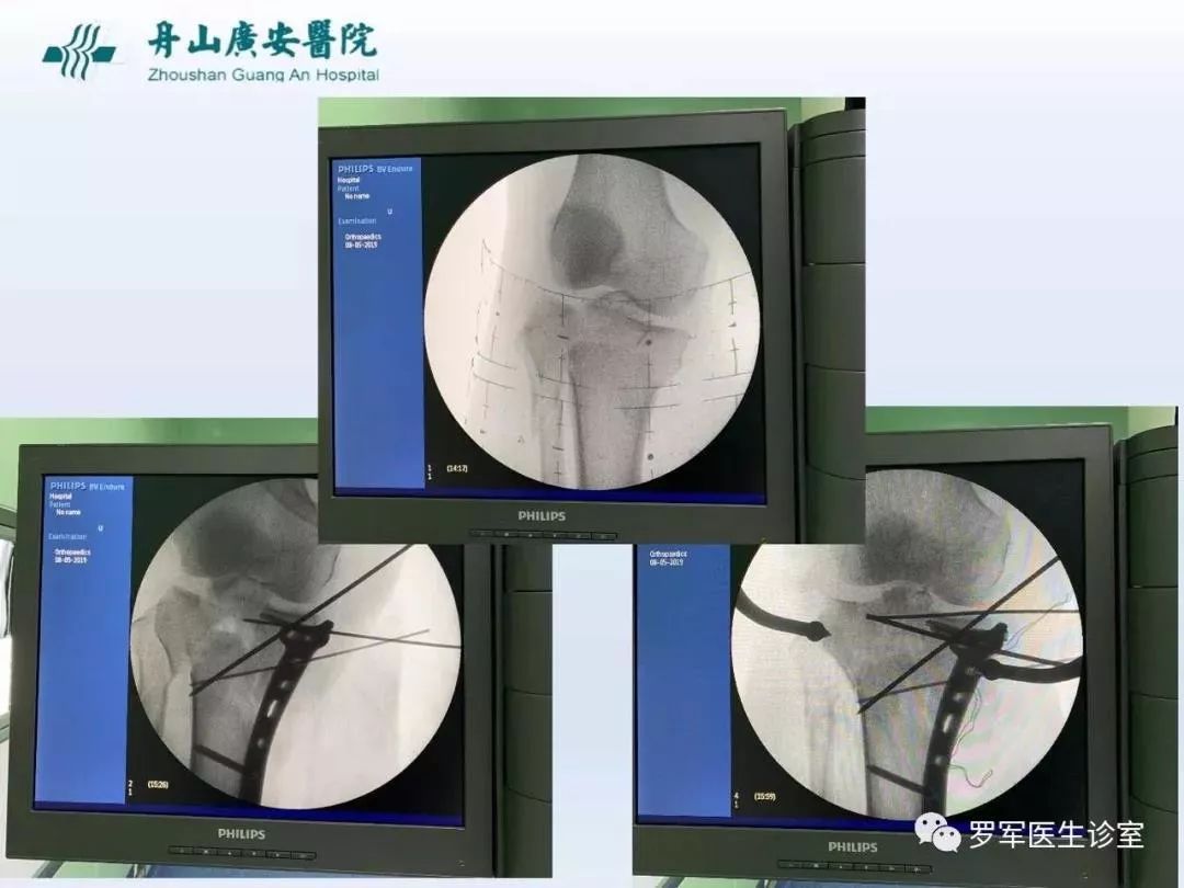 干货分享！脱位型胫骨平台骨折的手术治疗体会