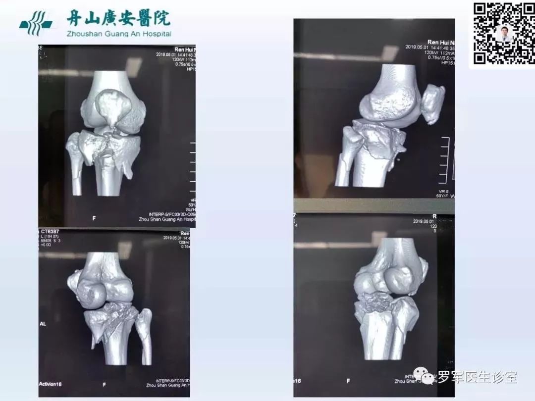 干货分享！脱位型胫骨平台骨折的手术治疗体会
