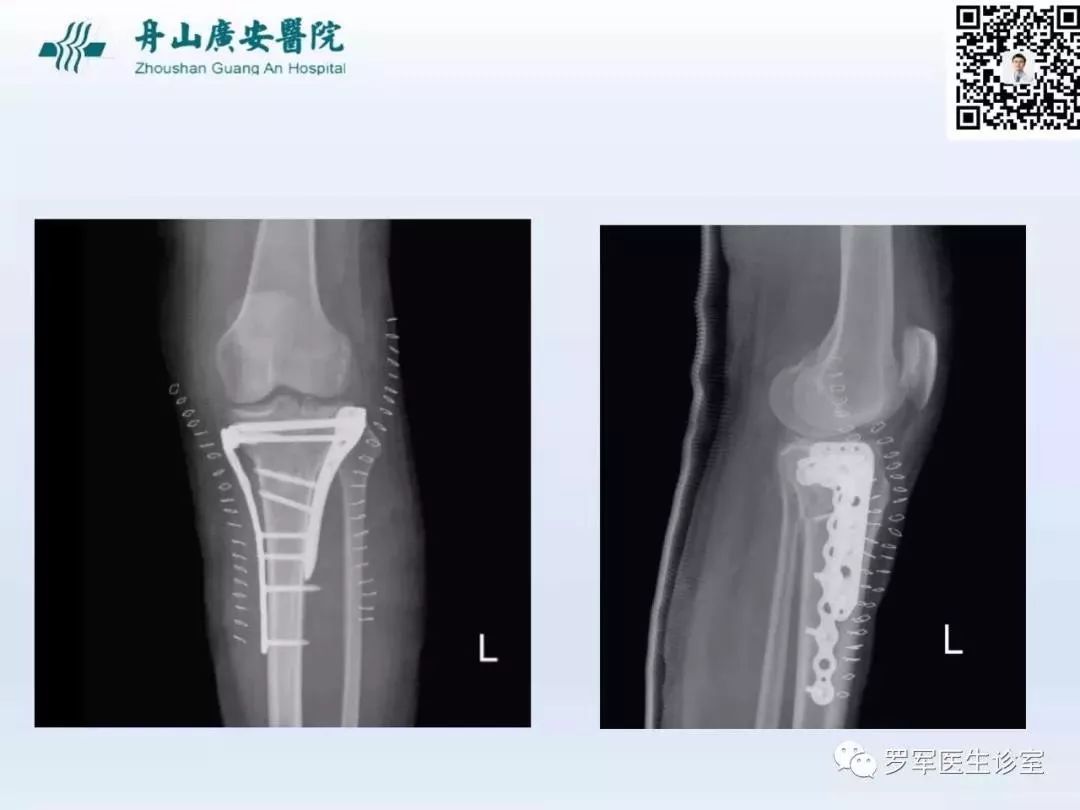 干货分享！脱位型胫骨平台骨折的手术治疗体会