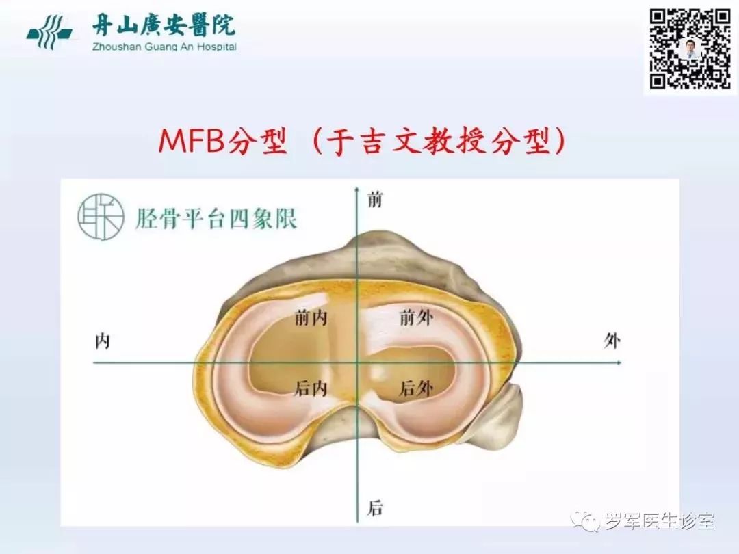 干货分享！脱位型胫骨平台骨折的手术治疗体会