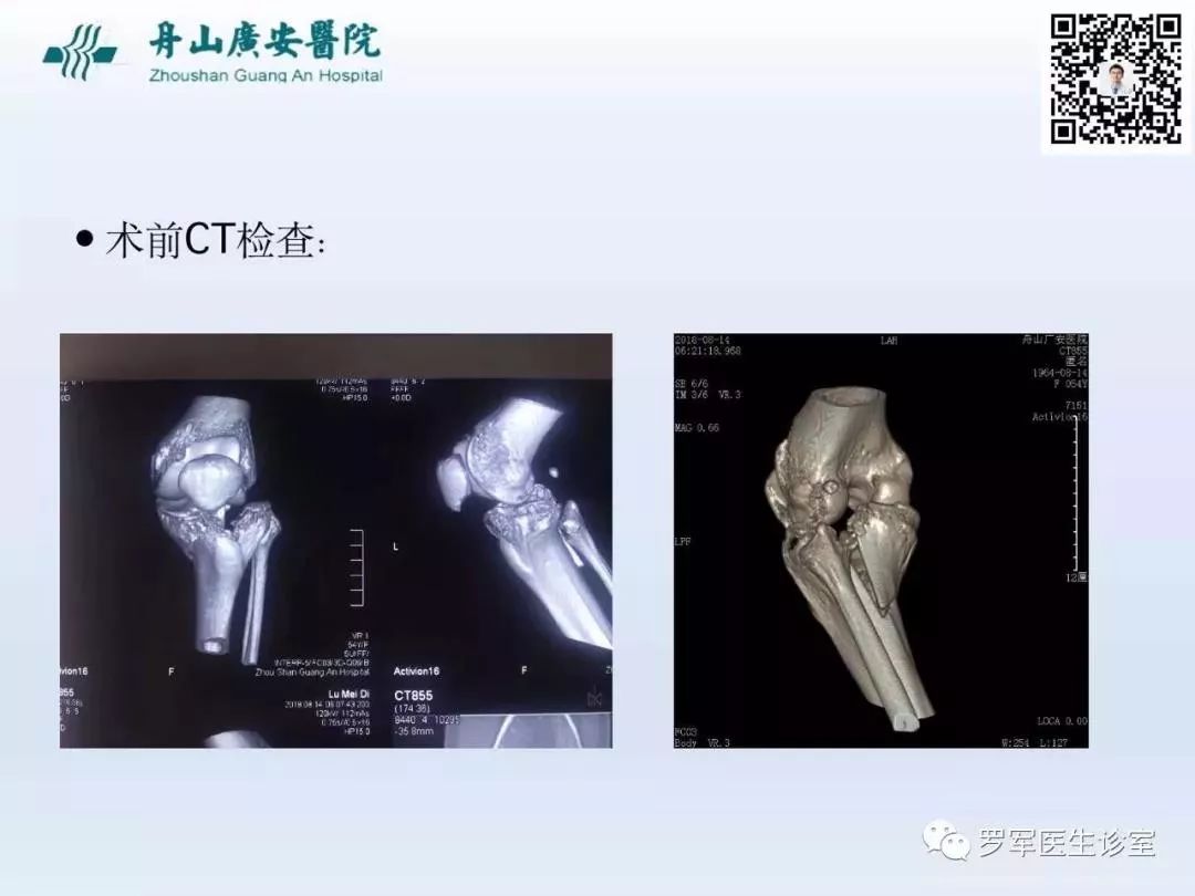 干货分享！脱位型胫骨平台骨折的手术治疗体会