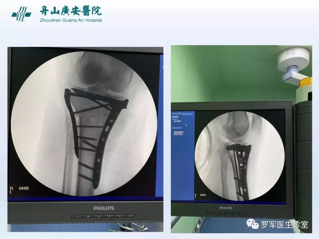 干货分享！脱位型胫骨平台骨折的手术治疗体会