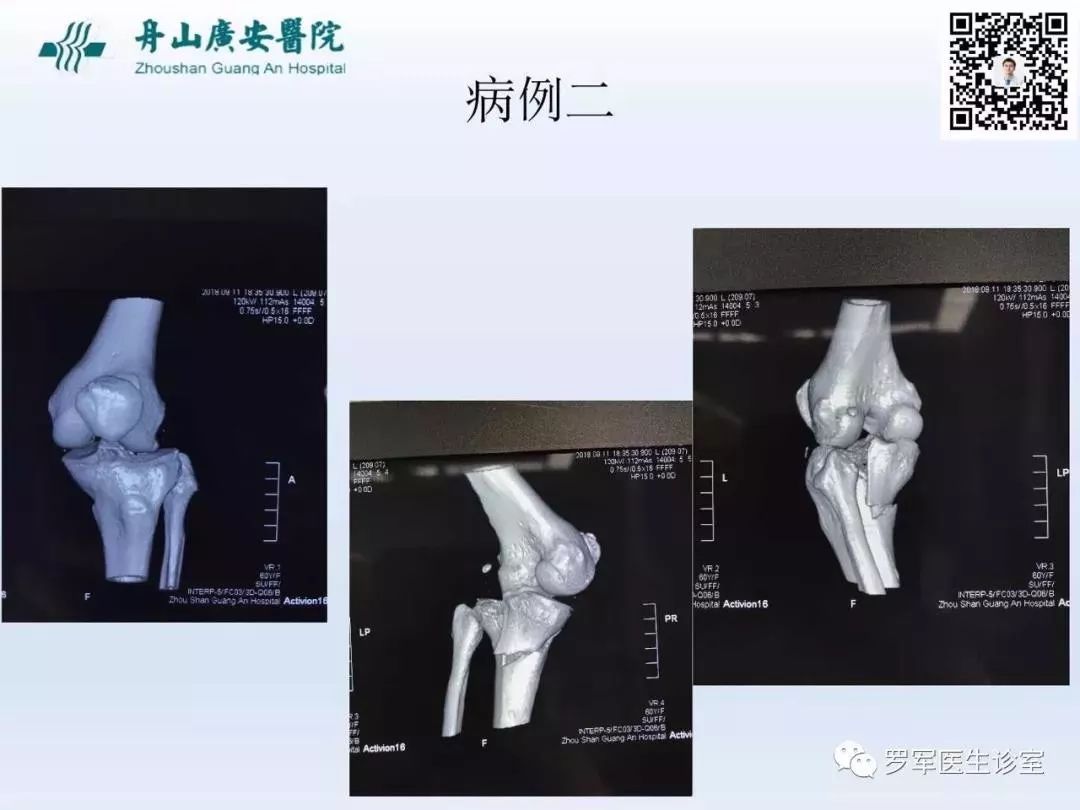 干货分享！脱位型胫骨平台骨折的手术治疗体会