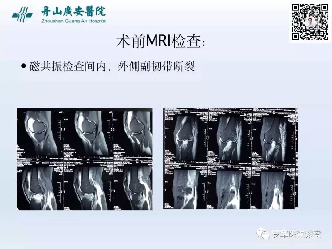 干货分享！脱位型胫骨平台骨折的手术治疗体会