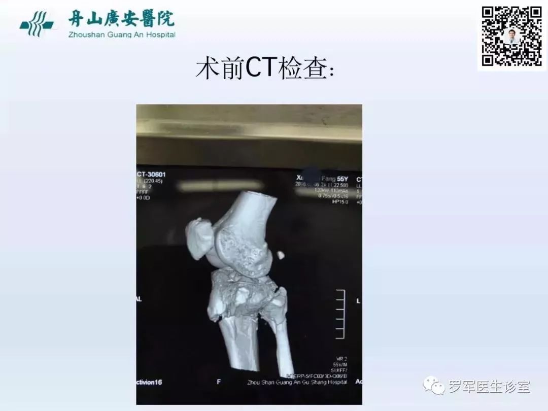 干货分享！脱位型胫骨平台骨折的手术治疗体会