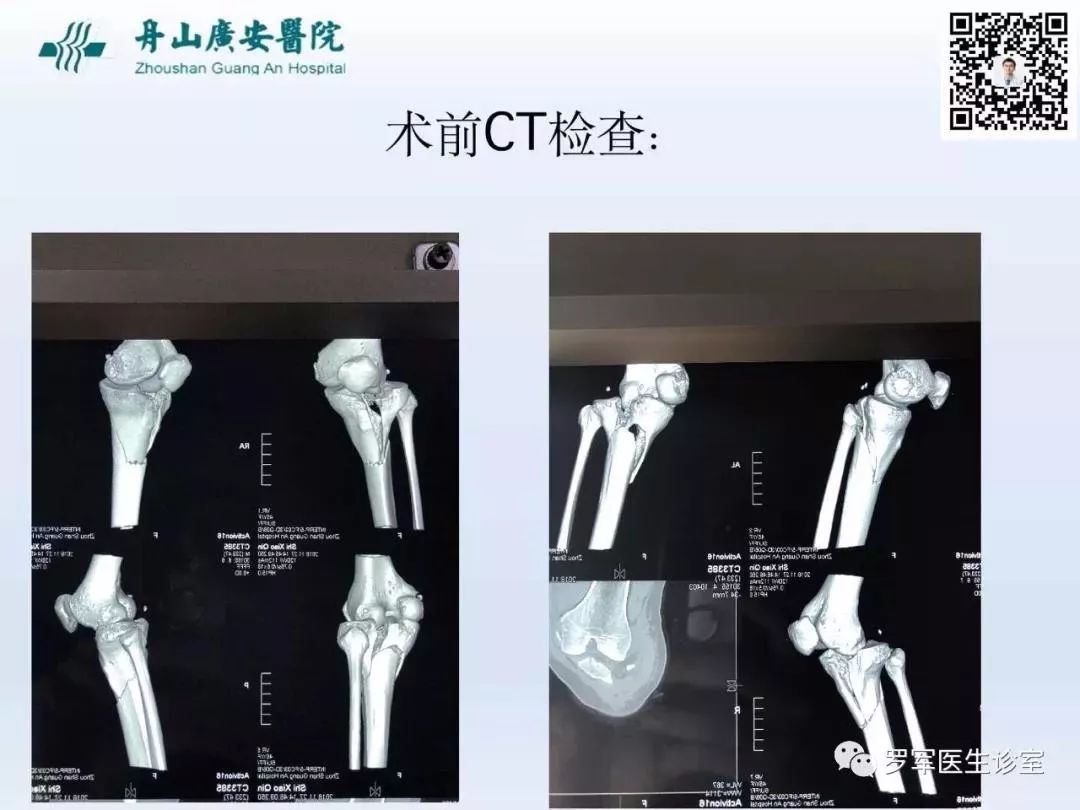 干货分享！脱位型胫骨平台骨折的手术治疗体会