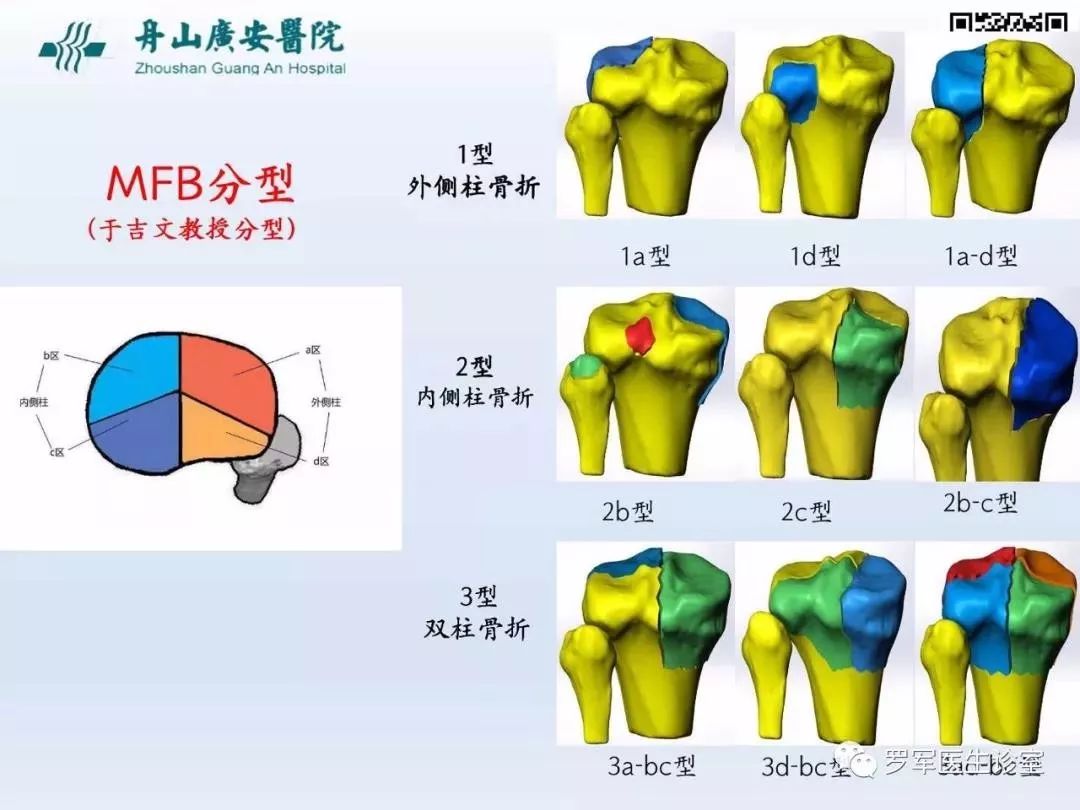 干货分享！脱位型胫骨平台骨折的手术治疗体会