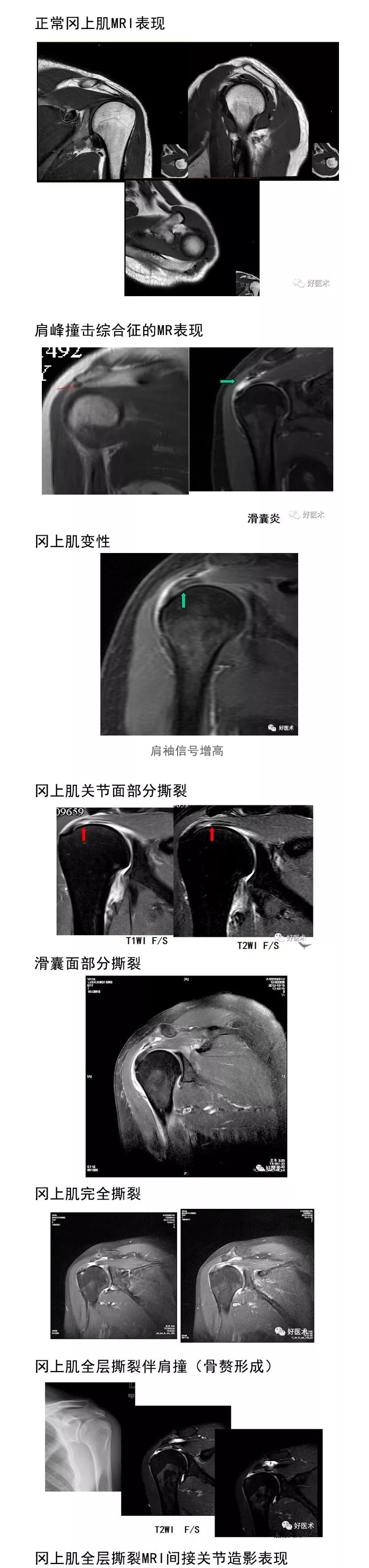 肩关节损伤的影像学诊断技巧，看这篇就够了！
