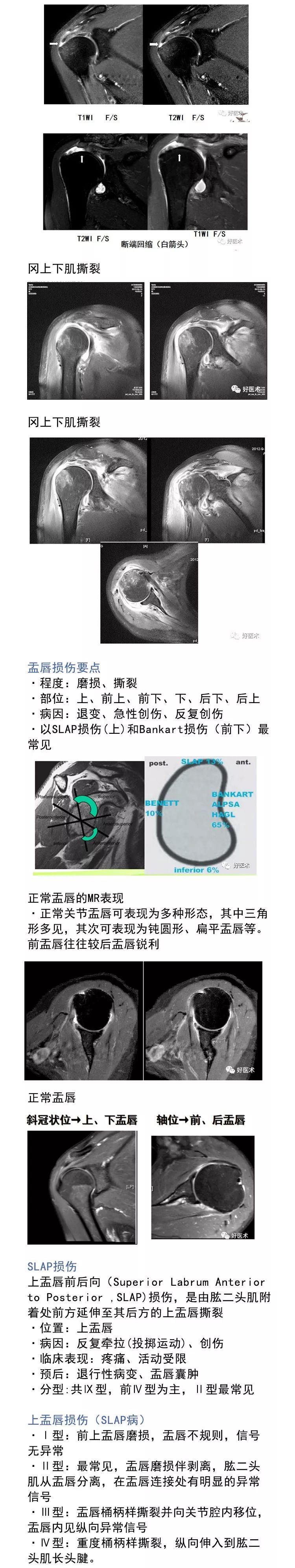 肩关节损伤的影像学诊断技巧，看这篇就够了！