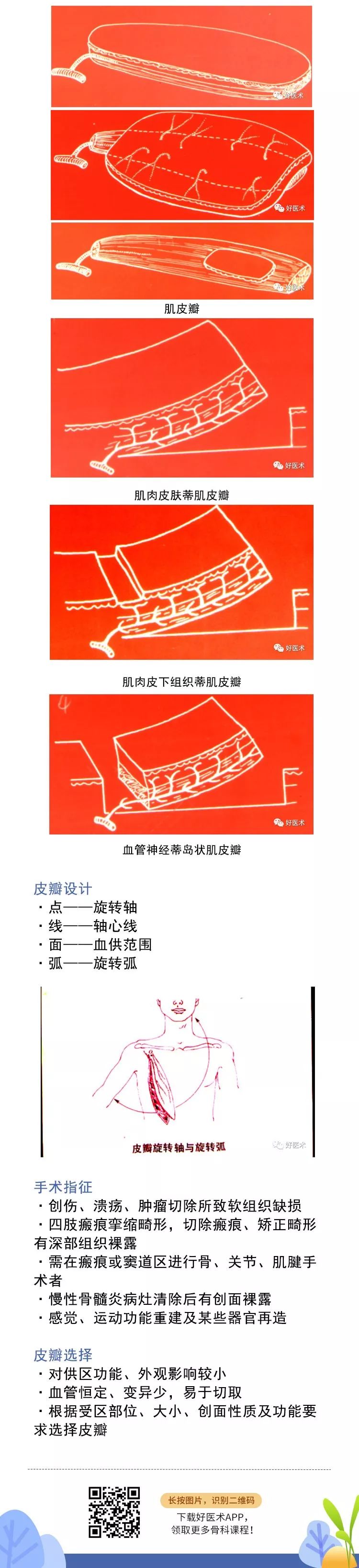 如何做好骨科创面的治疗与修复？