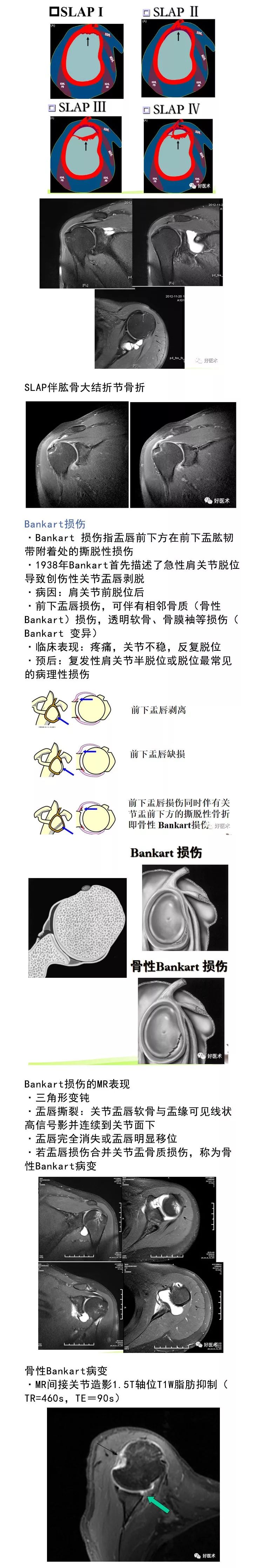 肩关节损伤的影像学诊断技巧，看这篇就够了！