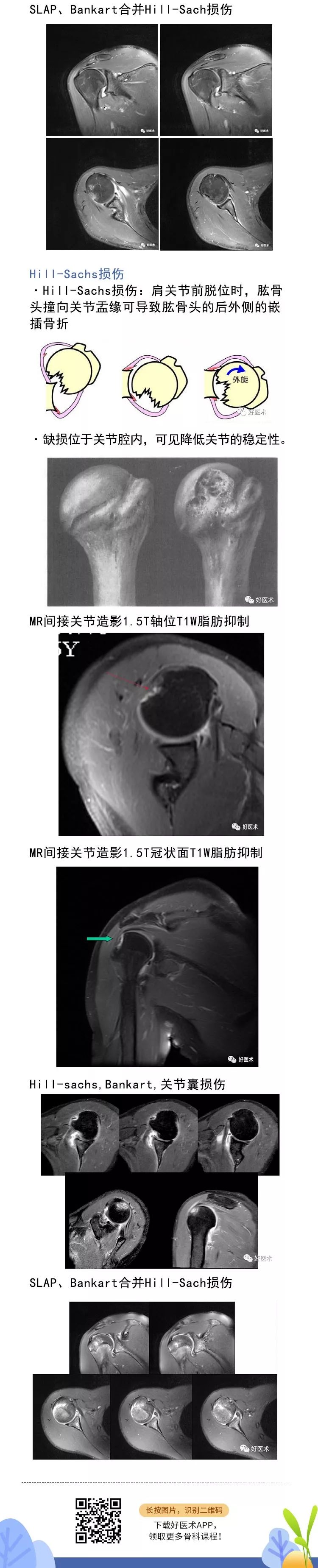 肩关节损伤的影像学诊断技巧，看这篇就够了！