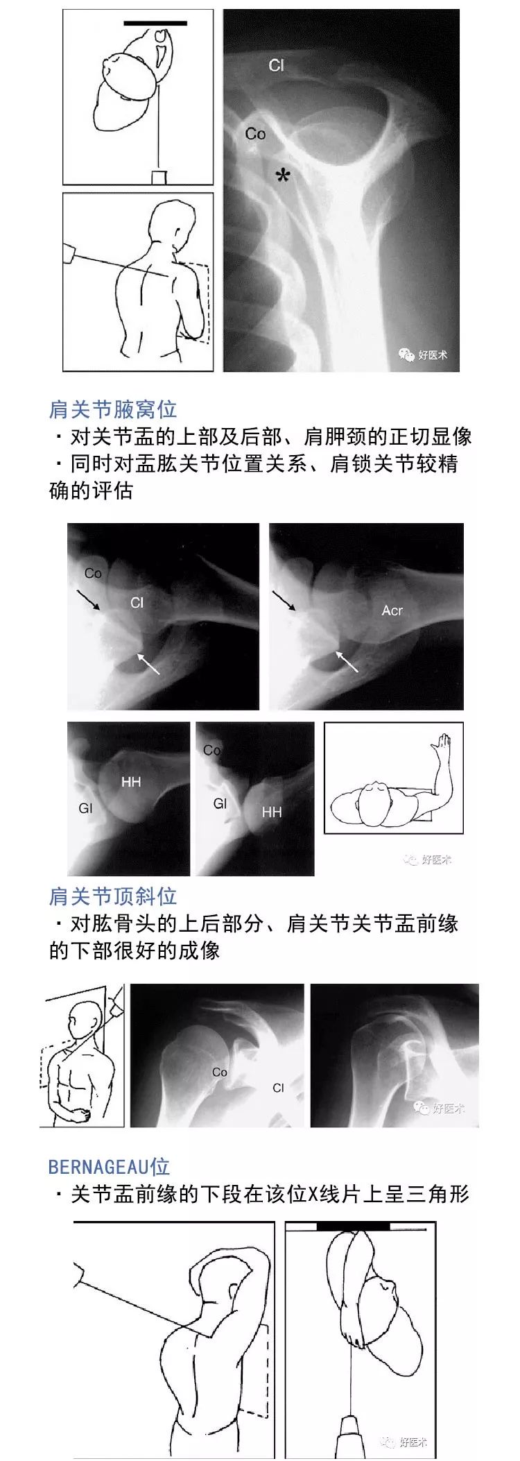 肩关节损伤的影像学诊断技巧，看这篇就够了！