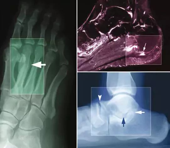 如何做好慢性足部疼痛的影像学评估？看这篇！