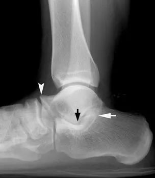 如何做好慢性足部疼痛的影像学评估？看这篇！