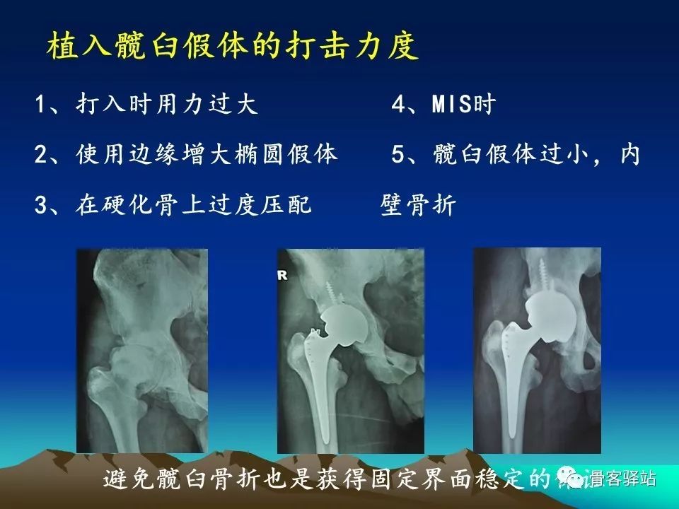 初次全髋关节置换术，技巧要点都在这！