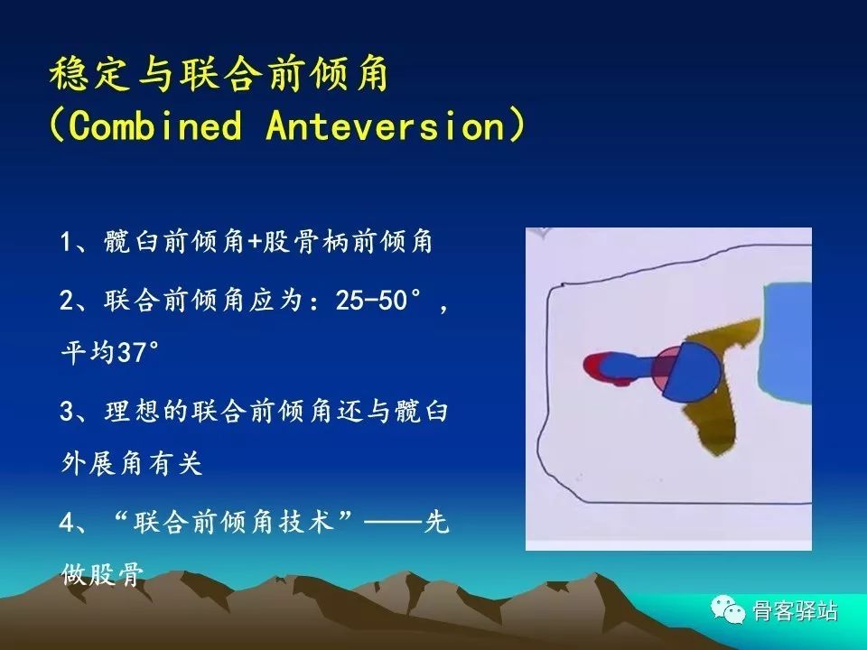 初次全髋关节置换术，技巧要点都在这！