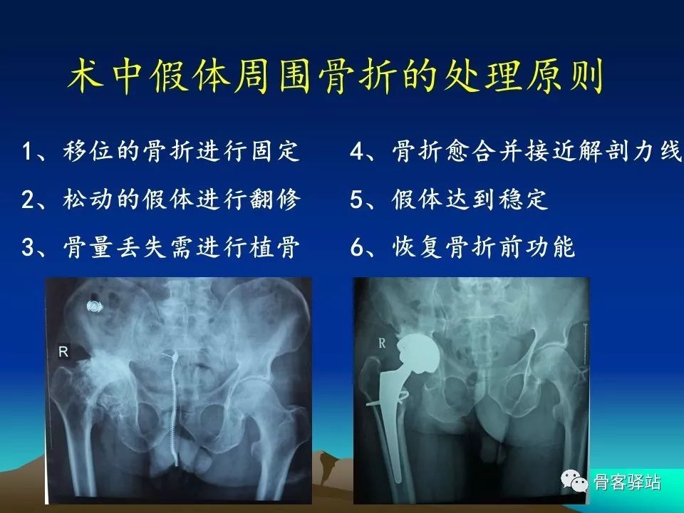 初次全髋关节置换术，技巧要点都在这！