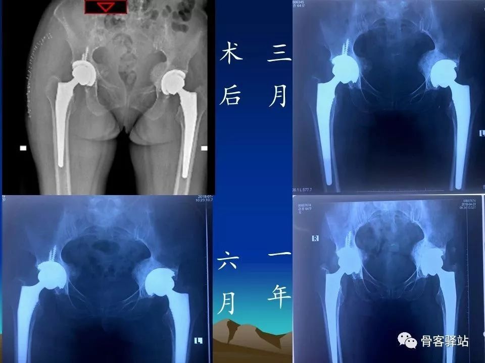 初次全髋关节置换术，技巧要点都在这！